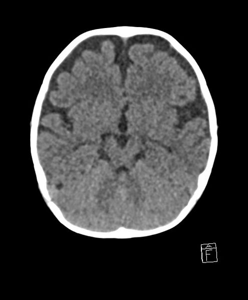 File:Benign enlargement of subarachnoid spaces in infancy (BESS) (Radiopaedia 87459-103795 Axial non-contrast 57).jpg