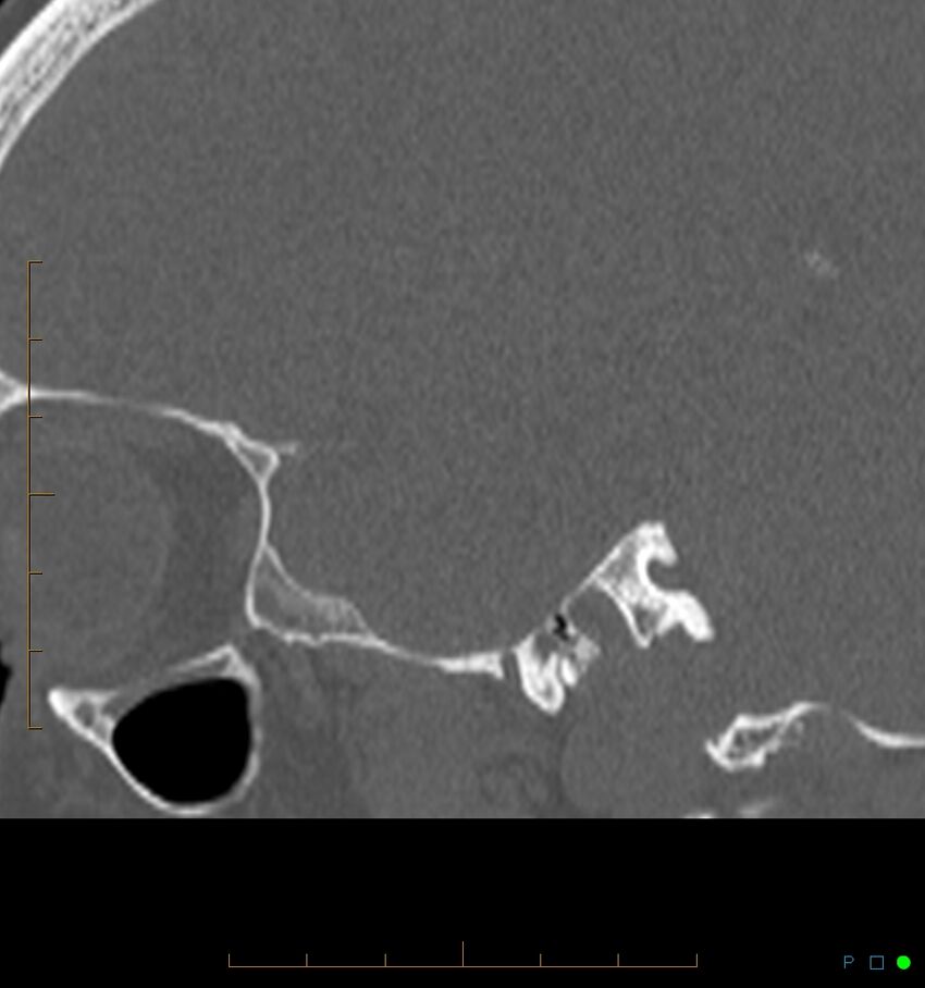 Benign notochordal cell tumor (probable) (Radiopaedia 65475-74546 Sagittal bone window 58).jpg