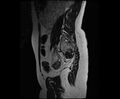 Bicornuate bicollis uterus (Radiopaedia 61626-69616 Sagittal T2 30).jpg