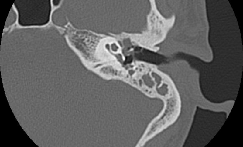 File:Bilateral cholesteatoma (Radiopaedia 54898-61172 C 17).jpg
