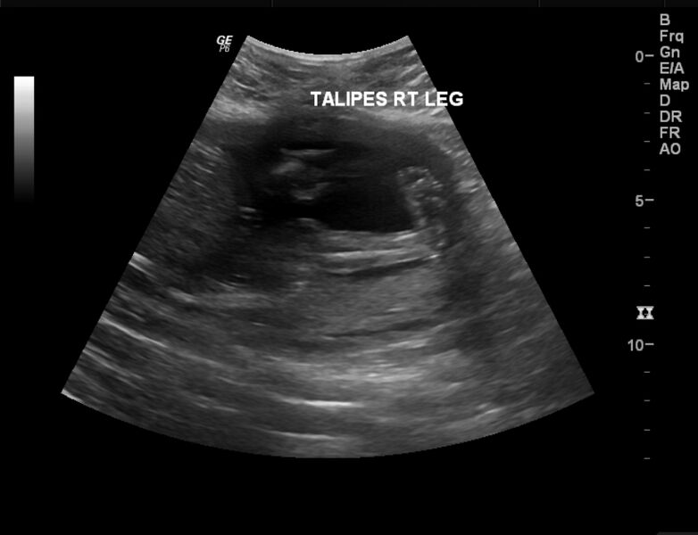 File:Bilateral congenital talipes equino-varus deformity in fetus (Radiopaedia 23337-23412 B 1).jpg