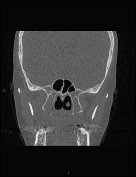 File:Bilateral frontal mucoceles (Radiopaedia 82352-96454 Coronal 223).jpg