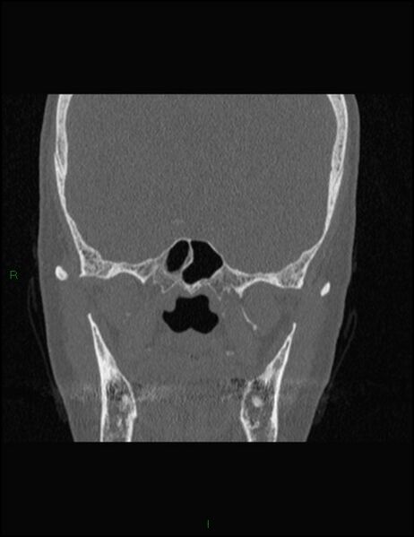 File:Bilateral frontal mucoceles (Radiopaedia 82352-96454 Coronal 234).jpg