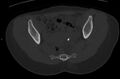 Bilateral mature cystic ovarian teratoma (Radiopaedia 88821-105592 Axial bone window 17).jpg