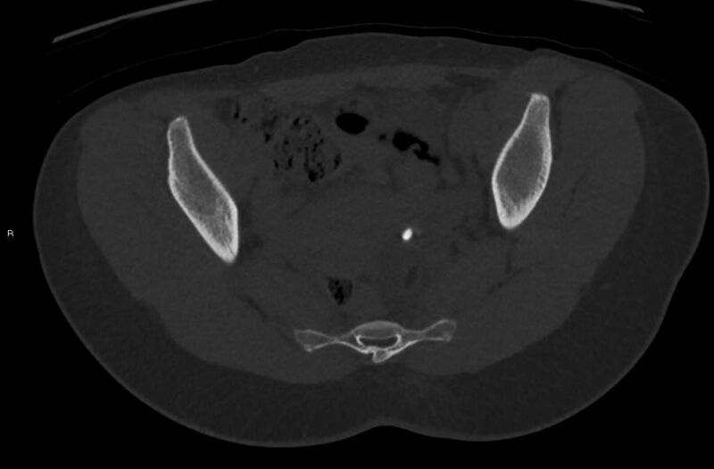 File:Bilateral mature cystic ovarian teratoma (Radiopaedia 88821-105592 Axial bone window 17).jpg