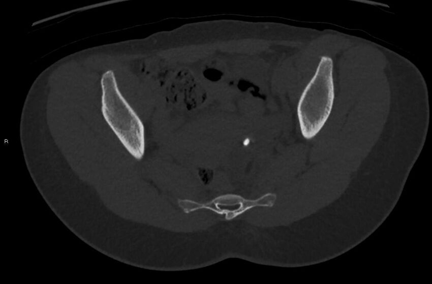 Bilateral mature cystic ovarian teratoma (Radiopaedia 88821-105592 Axial bone window 17).jpg
