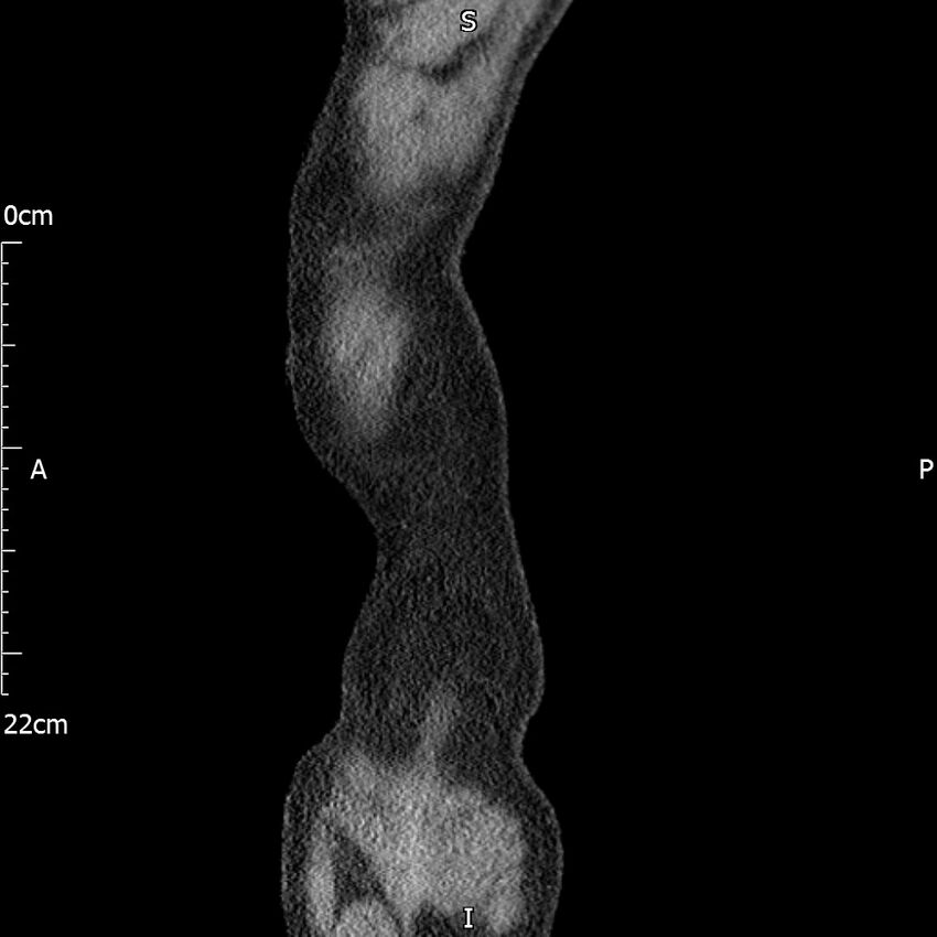 Bilateral medullary nephrocalcinosis with ureteric calculi (Radiopaedia 71269-81569 C 110).jpg