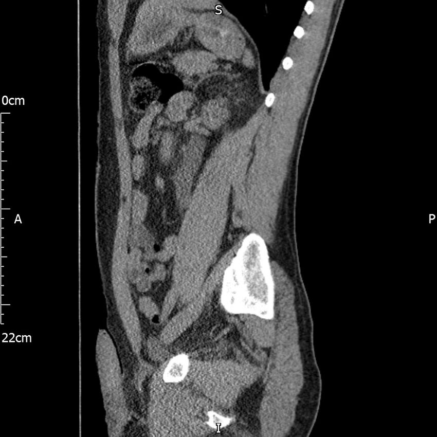 Bilateral medullary nephrocalcinosis with ureteric calculi (Radiopaedia 71269-81569 C 45).jpg