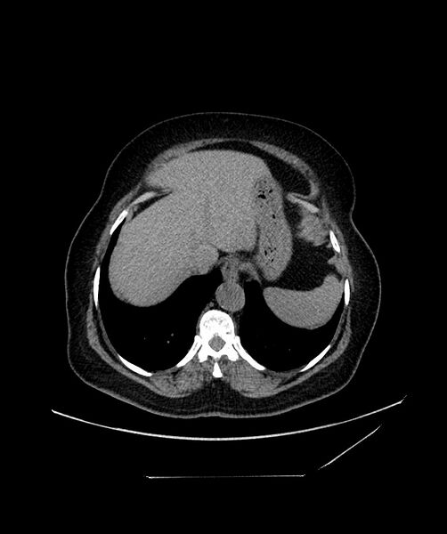 File:Bilateral sporadic synchronous clear cell renal cell carcinoma (Radiopaedia 85035-100573 Axial non-contrast 20).jpg