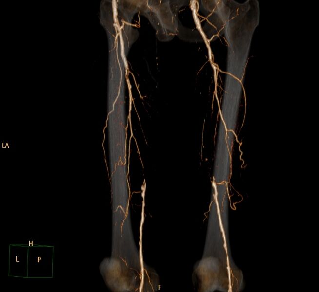 File:Bilateral superficial femoral arterial occlusion (Radiopaedia 25682-25857 3D VR 13).jpg