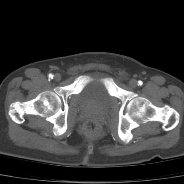 File:Bilateral superficial femoral arterial occlusion (Radiopaedia 25682-25857 A 26).jpg