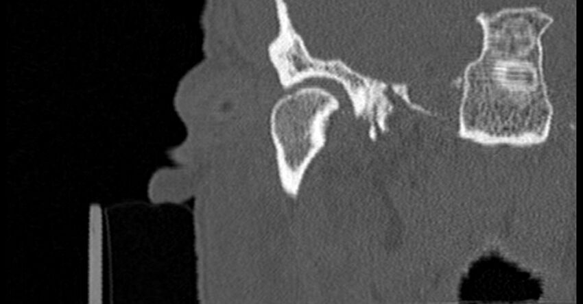Bilateral temporal bone fractures (Radiopaedia 29482-29970 Coronal non-contrast 54).jpg