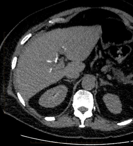 File:Bile leak from accessory duct(s) of Luschka post cholecystectomy (Radiopaedia 40736-43389 A 21).jpg