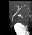 Bile leak from accessory duct(s) of Luschka post cholecystectomy (Radiopaedia 40736-43389 D 27).jpg