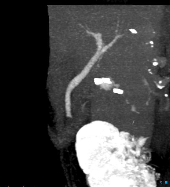 File:Bile leak from accessory duct(s) of Luschka post cholecystectomy (Radiopaedia 40736-43389 D 27).jpg