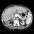 Biliary necrosis - liver transplant (Radiopaedia 21876-21846 B 26).jpg
