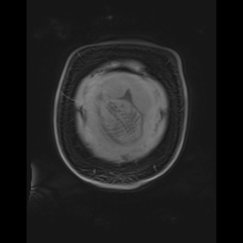 Bilobed placenta accreta (Radiopaedia 69648-79591 Coronal T1 vibe 17).jpg