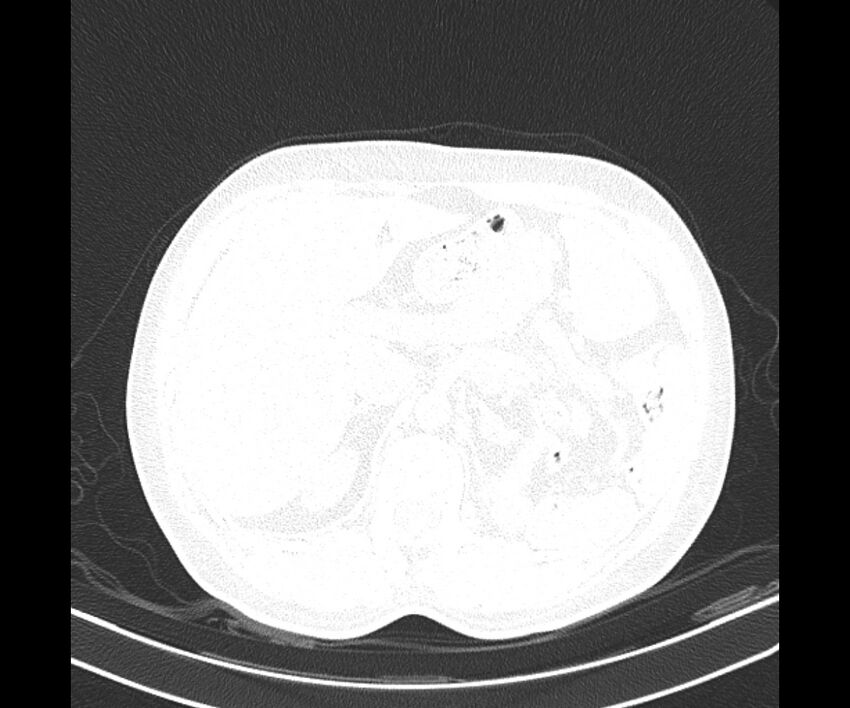 Bochdalek hernia - adult presentation (Radiopaedia 74897-85925 Axial lung window 46).jpg