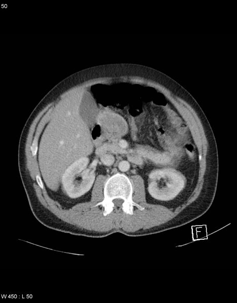 File:Boerhaave syndrome with tension pneumothorax (Radiopaedia 56794-63603 A 25).jpg