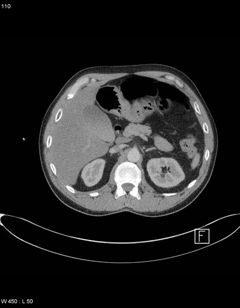 File:Boerhaave syndrome with tension pneumothorax (Radiopaedia 56794-63605 A 54).jpg