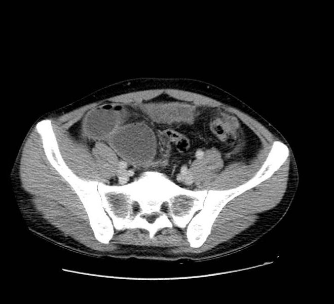 File:Bowel obstruction from colon carcinoma (Radiopaedia 22995-23028 A 65).jpg