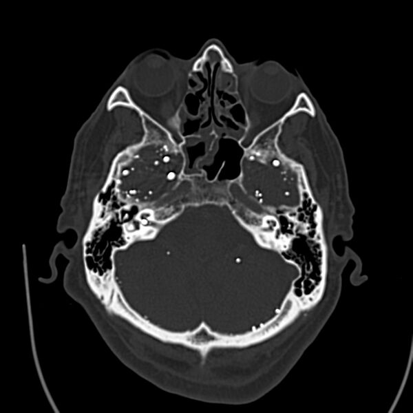 File:Brain Pantopaque remnants (Radiopaedia 78403-91048 Axial bone window 22).jpg