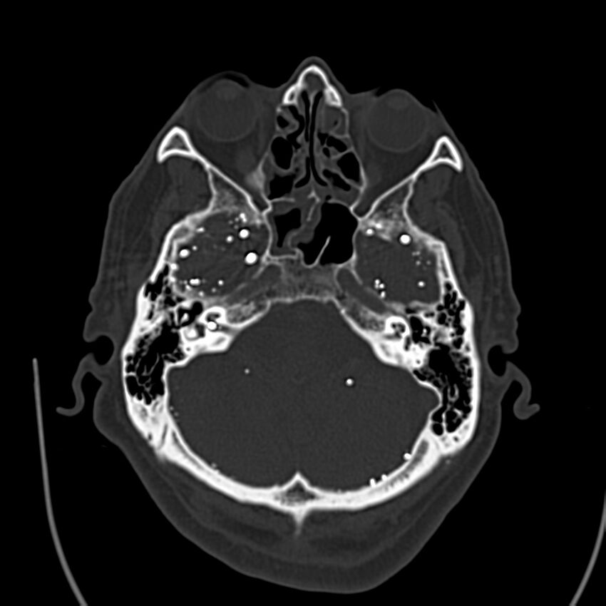 Brain Pantopaque remnants (Radiopaedia 78403-91048 Axial bone window 22).jpg