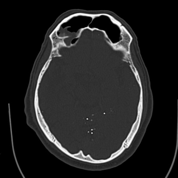File:Brain Pantopaque remnants (Radiopaedia 78403-91048 Axial bone window 32).jpg
