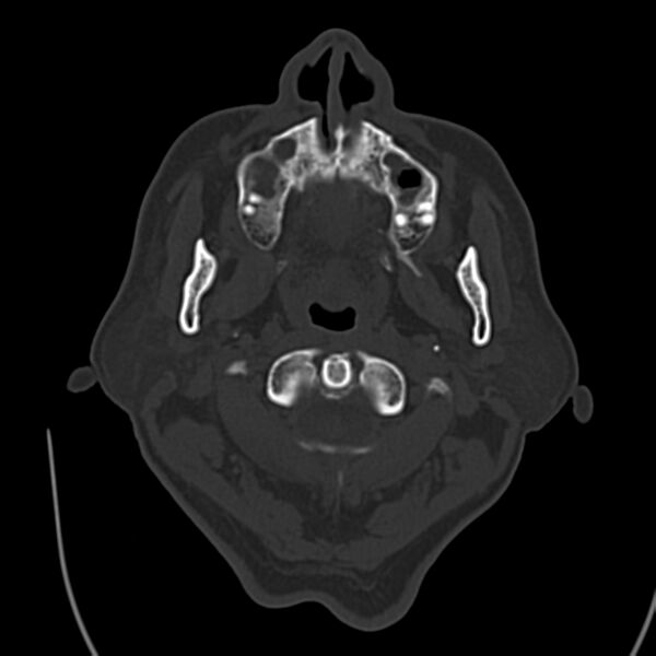 File:Brain Pantopaque remnants (Radiopaedia 78403-91048 Axial bone window 6).jpg