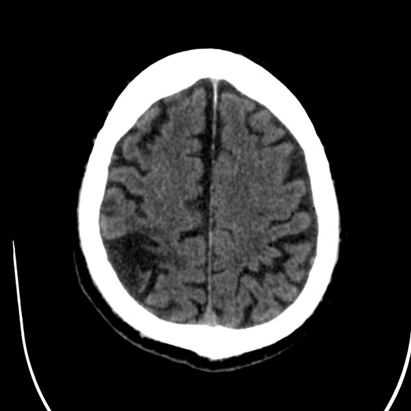 File:Brain Pantopaque remnants (Radiopaedia 78403-91048 Axial non-contrast 70).jpg