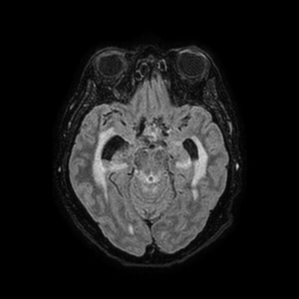 File:Brain abscess complicated by intraventricular rupture and ventriculitis (Radiopaedia 82434-96577 Axial FLAIR 23).jpg