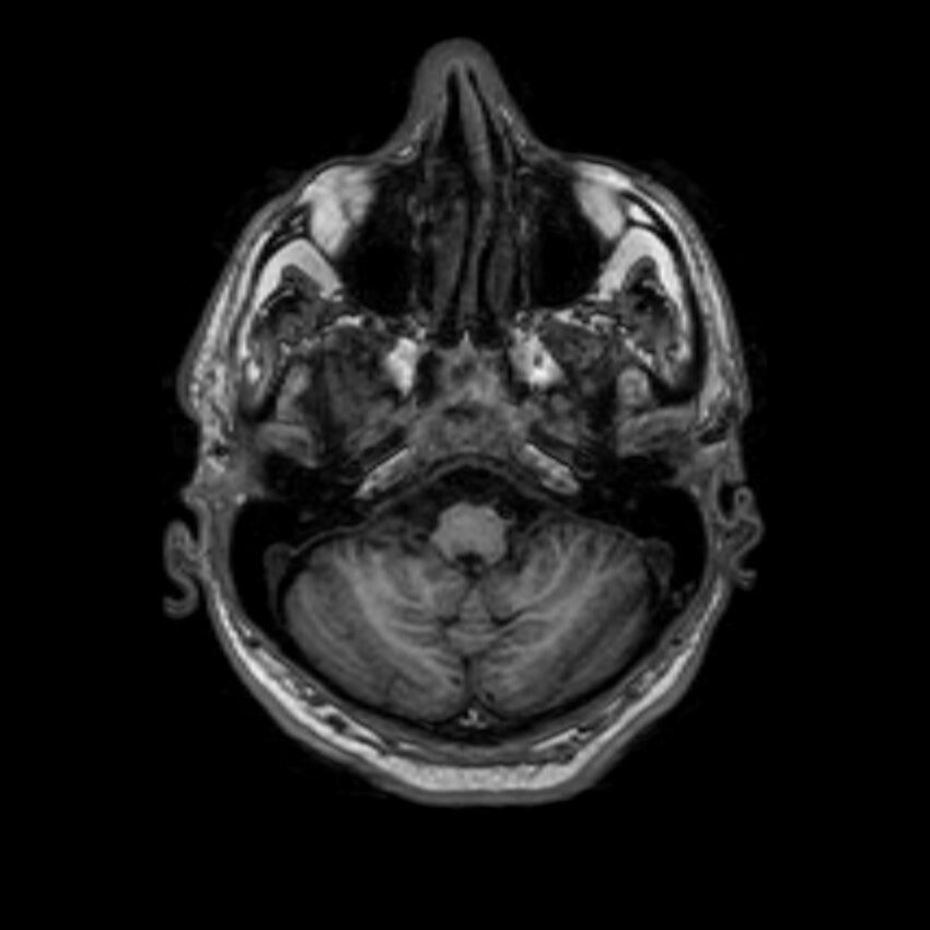 Brain abscess complicated by intraventricular rupture and ventriculitis (Radiopaedia 82434-96577 Axial T1 9).jpg