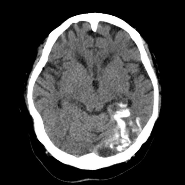 File:Brain cortical laminar necrosis (Radiopaedia 25822-25971 Axial non-contrast 18).jpg