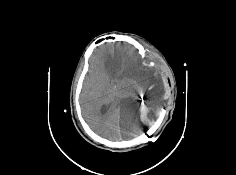 File:Brain injury by firearm projectile (Radiopaedia 82068-96087 B 109).jpg