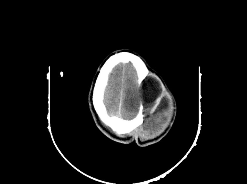 Brain injury by firearm projectile (Radiopaedia 82068-96088 A 182).jpg