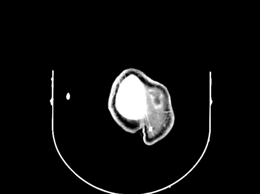 Brain injury by firearm projectile (Radiopaedia 82068-96088 B 202).jpg