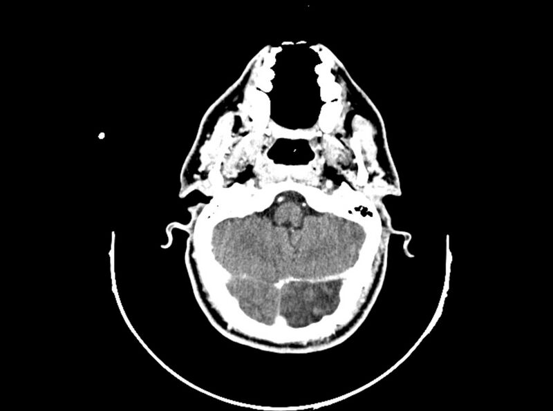 File:Brain injury by firearm projectile (Radiopaedia 82068-96088 B 75).jpg