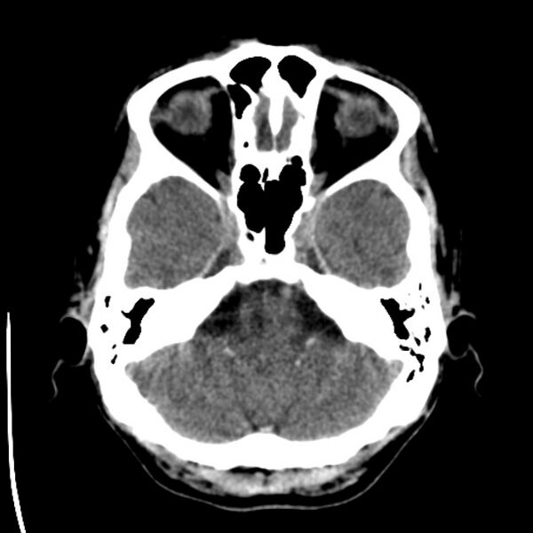 File:Brain metastases from lung cancer (Radiopaedia 24480-24781 Axial non-contrast 8).jpg