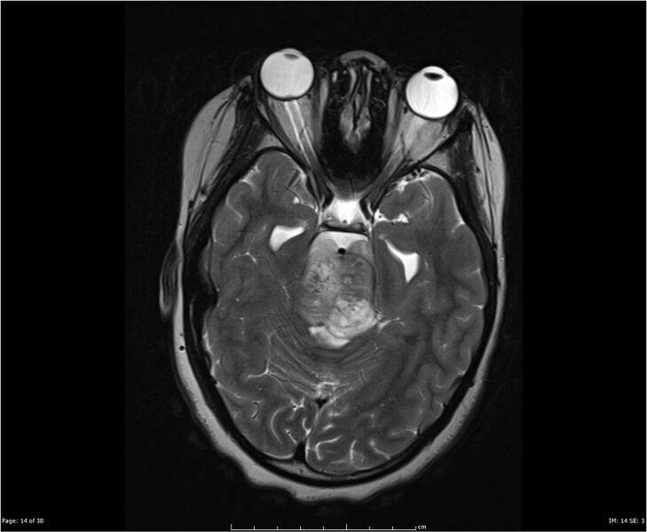 File:Brainstem glioma (Radiopaedia 21819-21775 Axial T2 14).jpg
