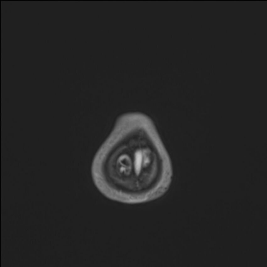 Brainstem glioma (Radiopaedia 70548-80674 Axial T1 C+ 151).jpg