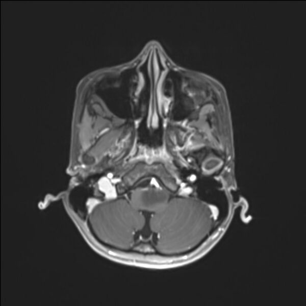 File:Brainstem glioma (Radiopaedia 70548-80674 Axial T1 C+ 31).jpg