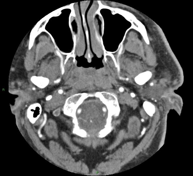 File:Brainstem hemorrhage (Radiopaedia 58794-66028 D 18).jpg