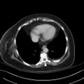 Breast carcinoma with pathological hip fracture (Radiopaedia 60314-67974 B 3).jpg