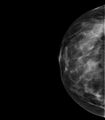 Breast lipoma (Radiopaedia 16321-16004 CC 1).jpg
