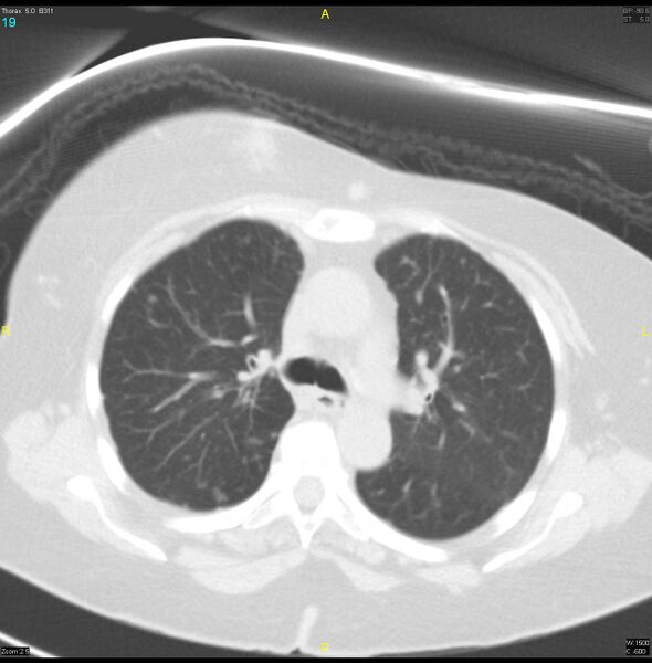 File:Breast primary with lung and bone metastases (Radiopaedia 40620-43228 Axial lung window 19).jpg
