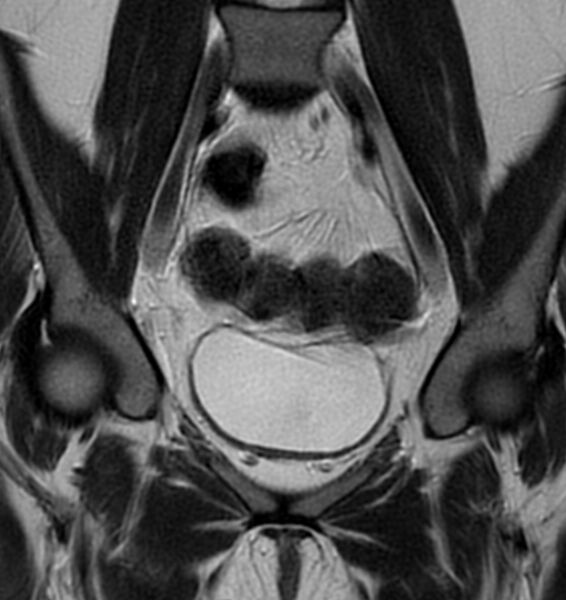 File:Broad ligament leiomyoma (Radiopaedia 81634-95516 Coronal T2 8).jpg