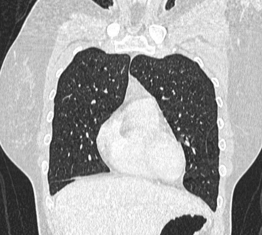 Bronchial atresia (Radiopaedia 50007-55297 Coronal lung window 21).jpg