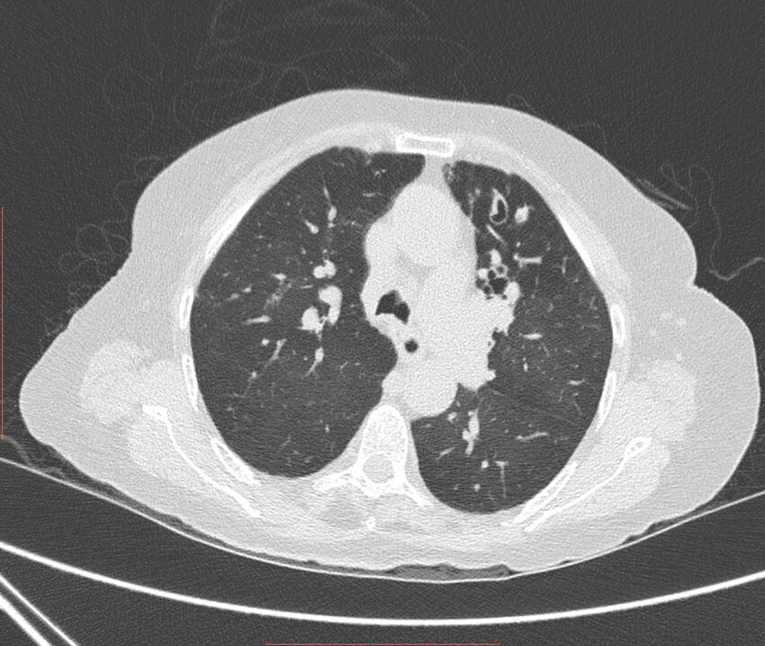Bronchiectasis (Radiopaedia 72693-83293 Axial lung window 47).jpg