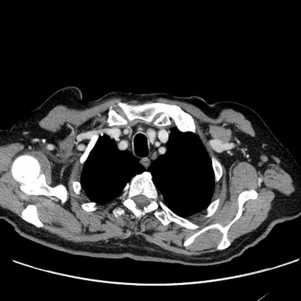 File:Bronchogenic carcinoma with L1 vertebra metastasis (Radiopaedia 9096-9805 Axial C+ delayed 2).jpg