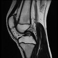Bucket handle tear - lateral meniscus (Radiopaedia 72124-82634 Sagittal T2 9).jpg